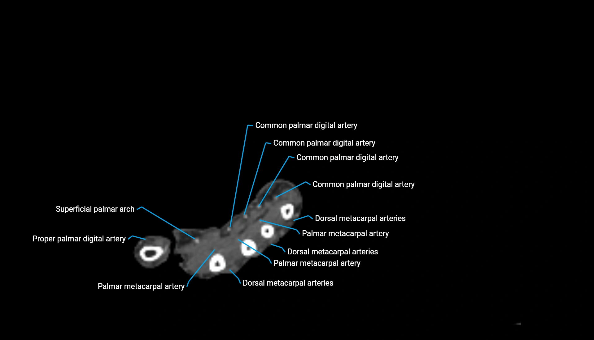CTA upper limb axial cross sectional anatomy labelled image 55 (2).webp